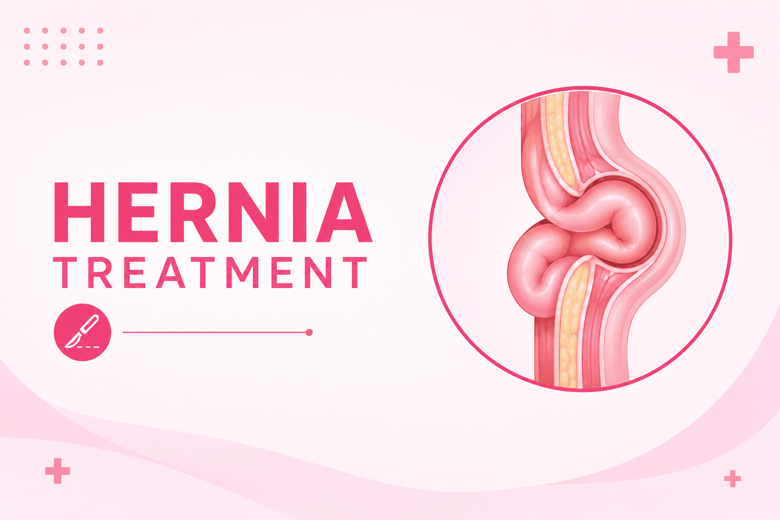 Best Hernia Treatment in Goregaon