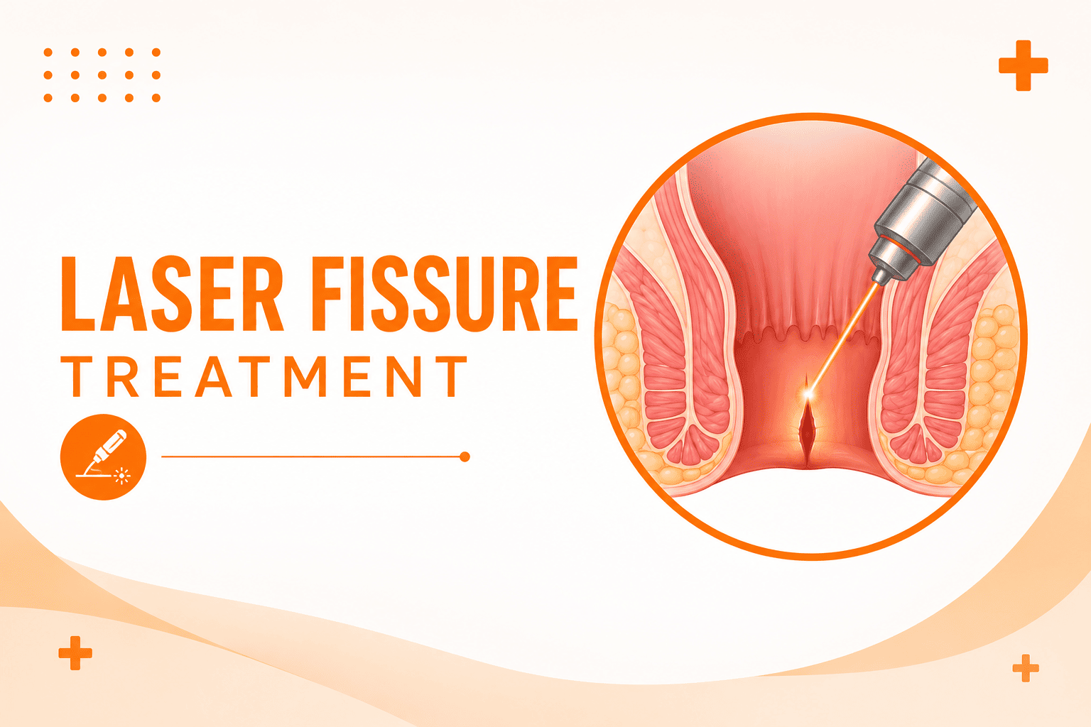 Best Laser Fissure Treatment in Andheri