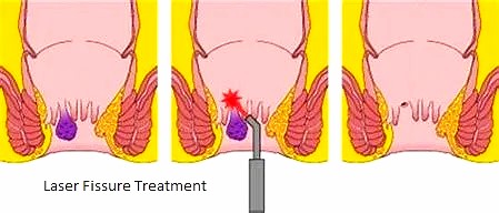 Best Laser Fissure Treatment in Andheri